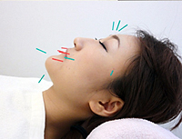 美容鍼灸の施術イメージ