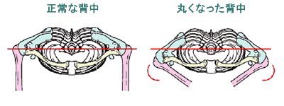 正常な背中と丸くなった背中